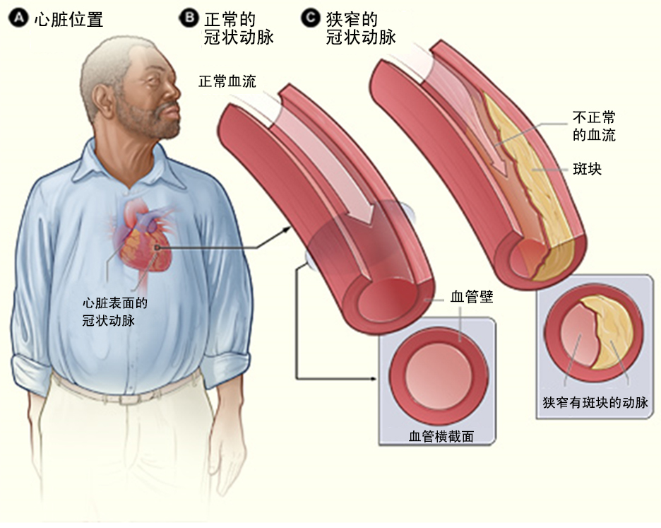 什么是冠心病?